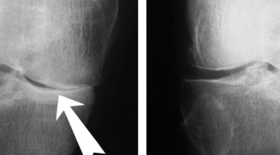 Prolotherapy for Healing Pain