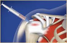 Prolotherapy for Healing Pain Innate Healthcare Institute