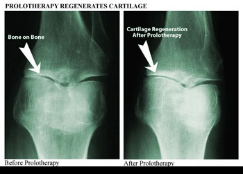 Stem Cell Therapy for Osteoarthritis Innate Healthcare Institute