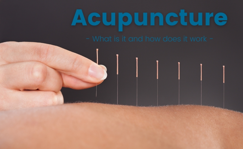 Acupuncture and Cupping – What is it and how does it work?